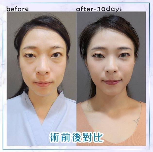 術前術後比對1