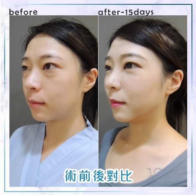 術前術後比對2
