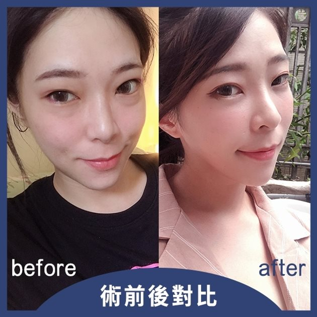 術前術後對比