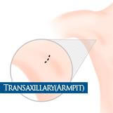 傳統腋下隆乳