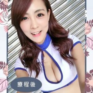 自體脂肪隆乳 vs. 果凍矽膠隆乳 – 如何挑選適合的隆乳手術方式?