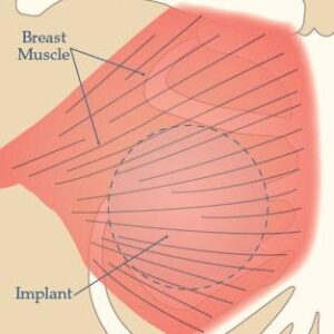 全胸大肌下隆乳