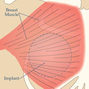 全胸大肌下隆乳