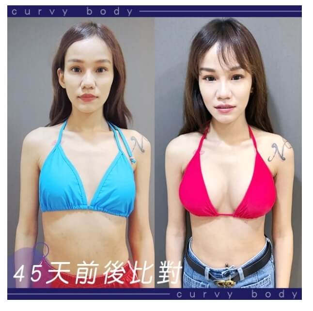 台北隆乳巨星林敬鈞醫師隆乳案例持續更新