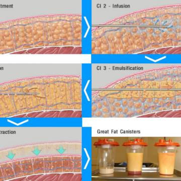 威塑抽脂,VASER – 威塑二代是產後婦女救星