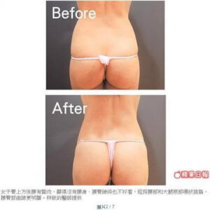 威塑抽脂雕塑-打造黃金美臀