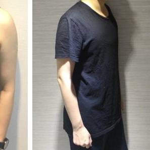 平胸手術Top-Surgery-FtM-–-擺脫束胸，做真實的自己