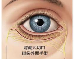 我該抽眼袋嗎？要順便補淚溝嗎？談眼袋手術