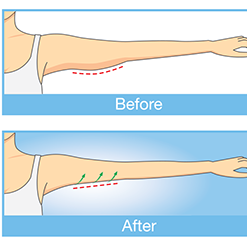 手臂抽脂-威塑-–-蝴蝶袖-bye-bye