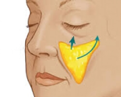 拉皮-–-臉部下垂救星