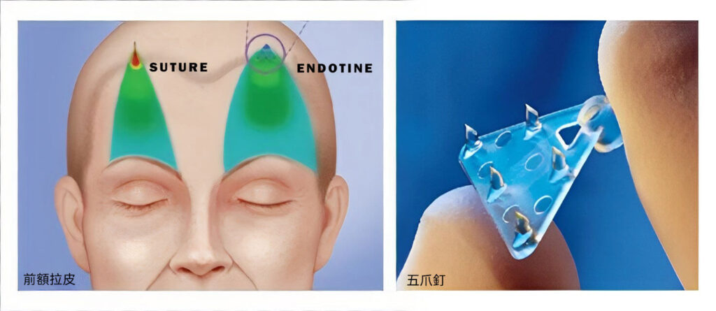 林敬鈞醫師 – 內視鏡五爪釘前額拉皮