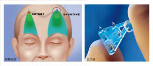 林敬鈞醫師 – 內視鏡五爪釘前額拉皮