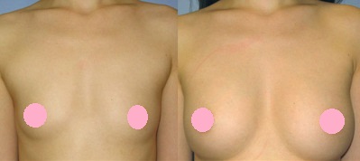 果凍矽膠隆乳圖片