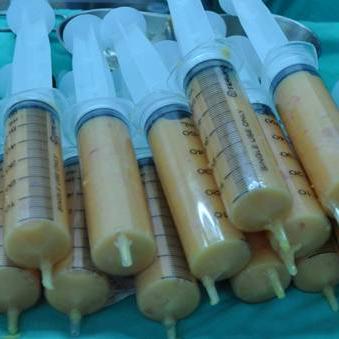 淺談自體脂肪隆乳