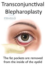 無痕眼袋內開–眼瞼外翻散退