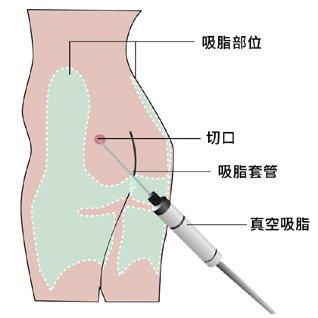 破除抽脂迷思，改善抽脂後遺症 – 談抽脂迷思
