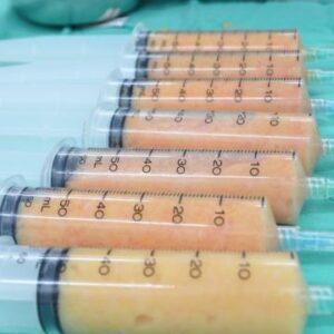 純手工至上!! 純手工局部抽脂搭配自體脂肪豐頰