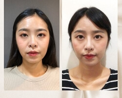 結構式隆鼻-–-改善鼻孔外露-塌塌鼻-韓式嘟嘟鼻順利成型