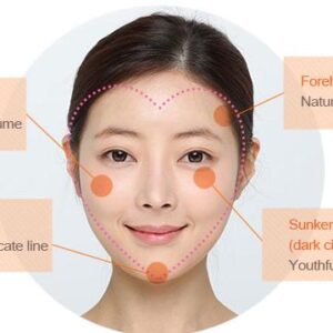 自體脂肪豐頰-–-天然ㄟ尚好