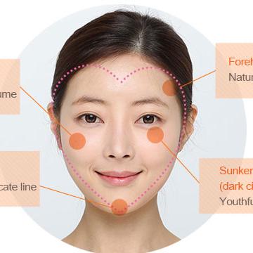 自體脂肪豐頰-–-天然ㄟ尚好