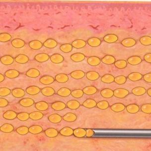 自體脂肪隆乳-–-術前必知與安全性