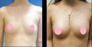 自體脂肪隆乳圖片