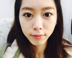 【複合式眼袋手術】小資女眼袋內開+全臉補脂全紀錄