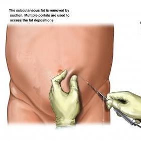 談抽脂技術演進