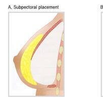 隆乳位置之評比