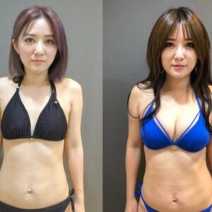 隆乳心得-自體脂肪隆乳vs.果凍矽膠隆乳-教你如何挑選適合的隆乳手術