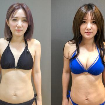 隆乳心得-自體脂肪隆乳vs.果凍矽膠隆乳-教你如何挑選適合的隆乳手術