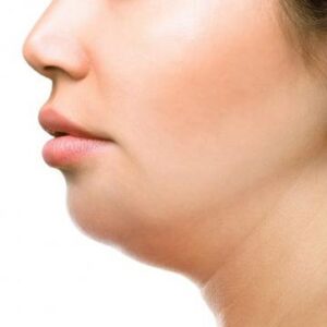 雙下巴抽脂-–-消除雙下巴與雕塑下臉龐曲線