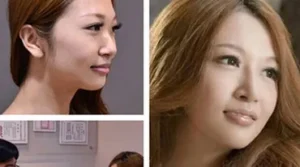 韓式結構式隆鼻