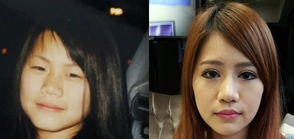 變臉成功：雙眼皮+韓式隆鼻