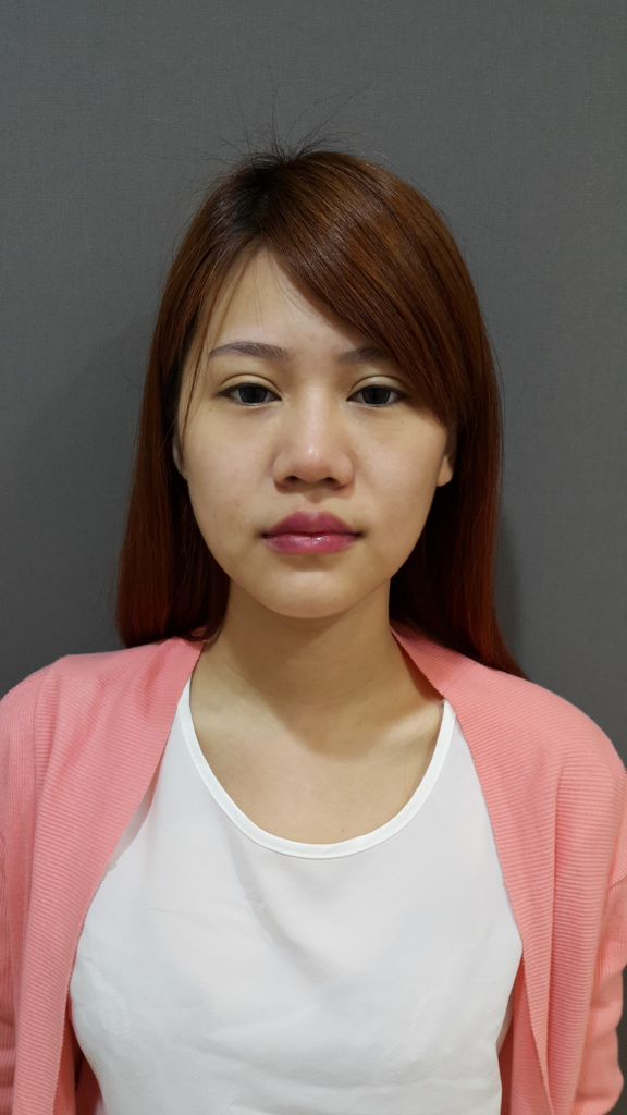 術前挑戰：玻尿酸隆鼻後，鼻樑反而變寬