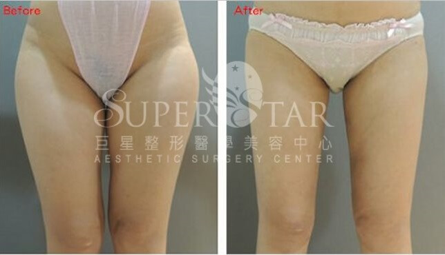 威塑大腿抽脂術前術後對比（案例實拍）