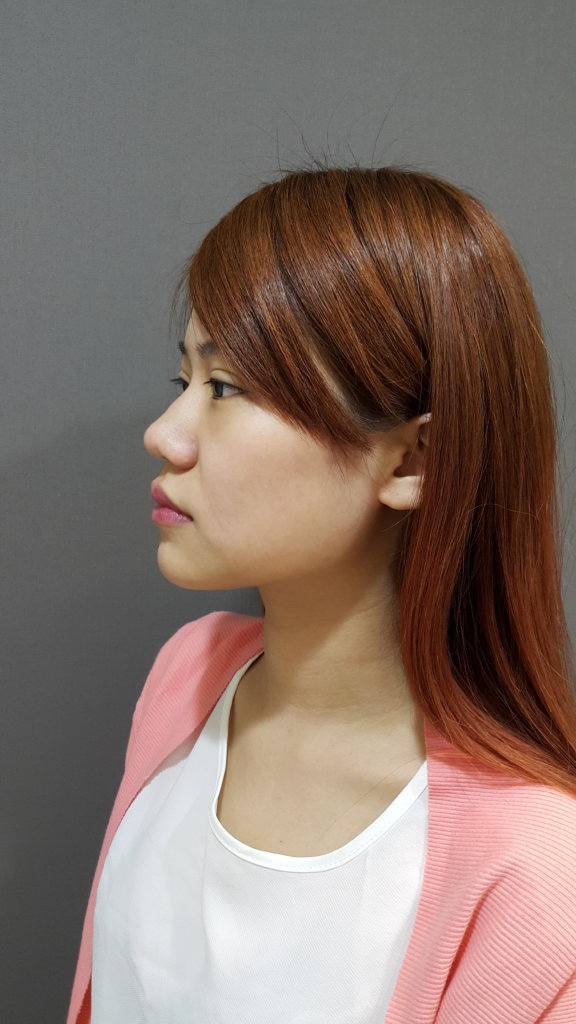 術前挑戰：玻尿酸隆鼻後，鼻樑反而變寬