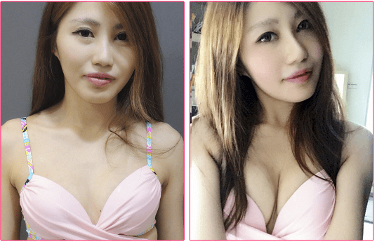 療程效果因人而異，圖片為該案例實際術後成效，請諮詢專業醫師