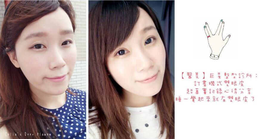 找到巨星整形外科 林敬鈞院長進行訂書針雙眼皮 (桃花眼) 手術，希望能讓眼神更有魅力，達到自然的混血萌雙眼皮效果