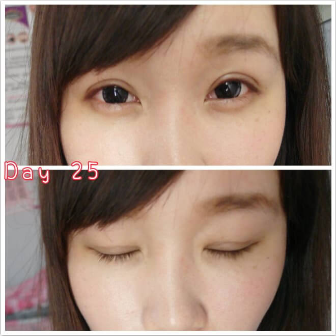 術後第二十五天：成果驗收