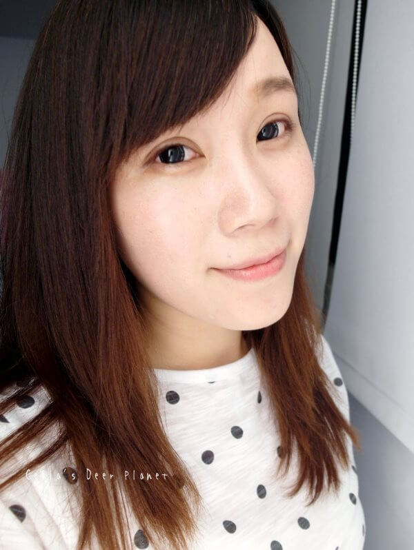 差不多一個月至一個半月才會完全消腫，但眼睛總算比較自然了