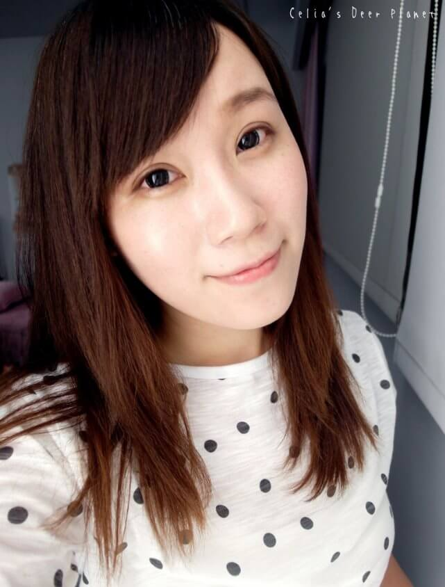 差不多一個月至一個半月才會完全消腫，但眼睛總算比較自然了