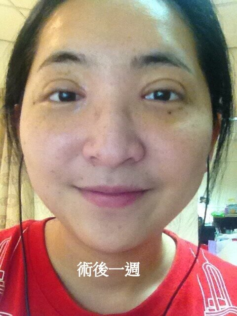 術後一週