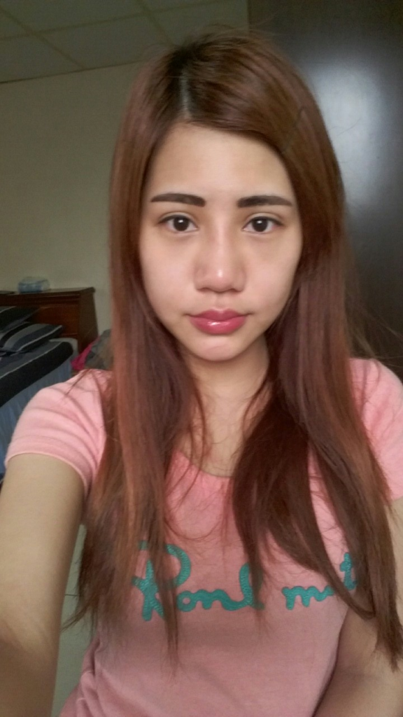 術後7天：外觀自然，開心重返工作崗位