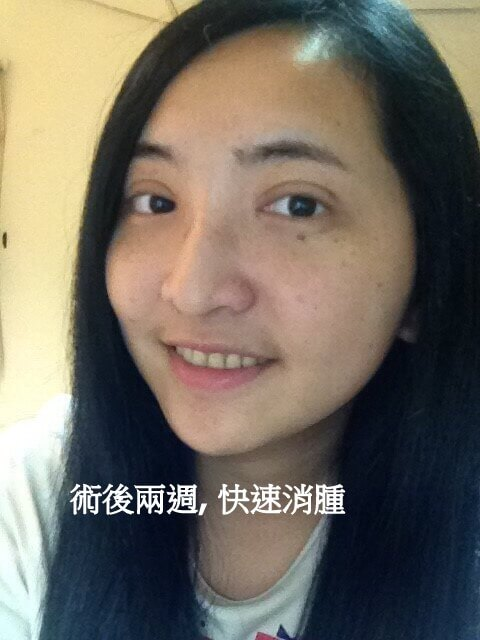 術後兩週