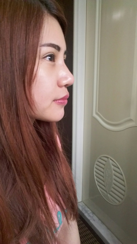 術後7天：外觀自然，開心重返工作崗位