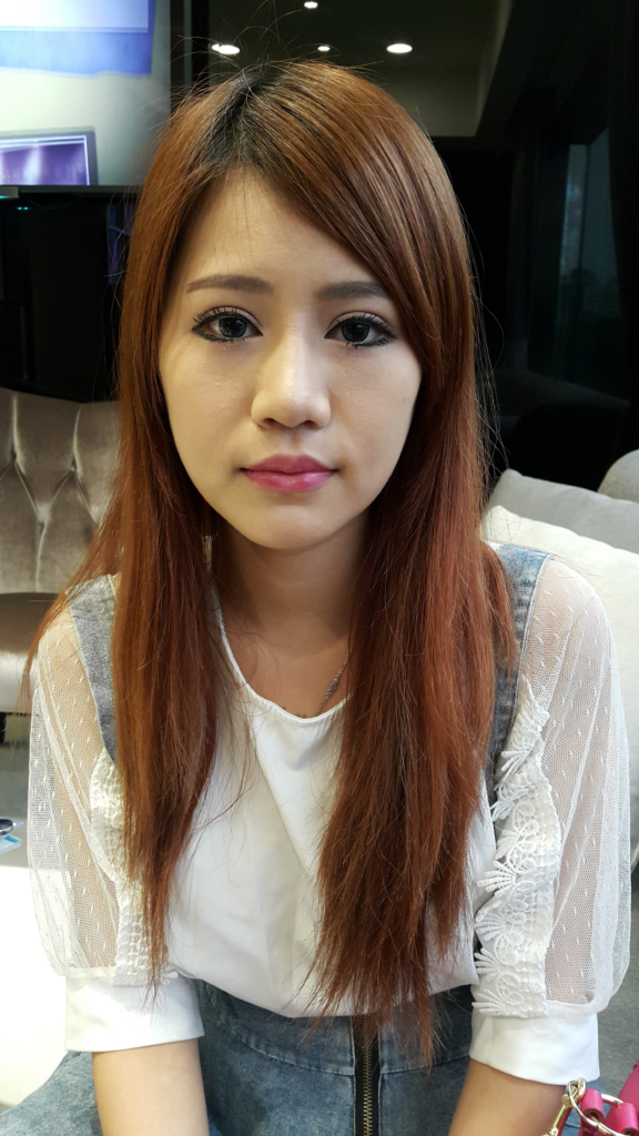 術後14天：消腫顯著，化妝後無痕跡