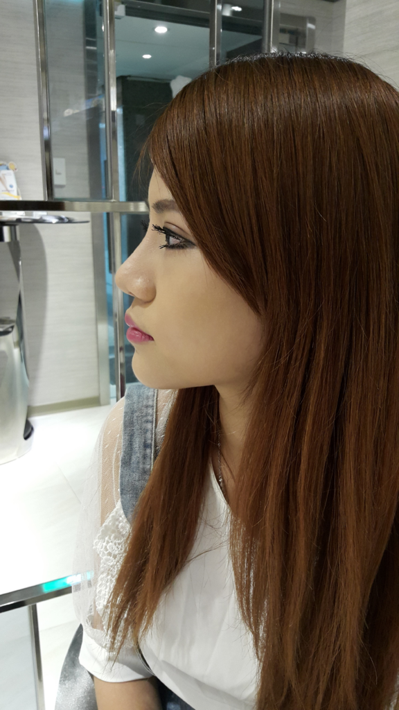 術後14天：消腫顯著，化妝後無痕跡