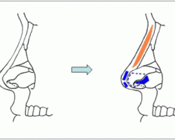 rhinoplasty-166(flat nose)