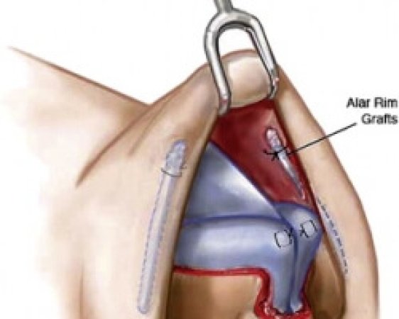 rhinoplasty-60